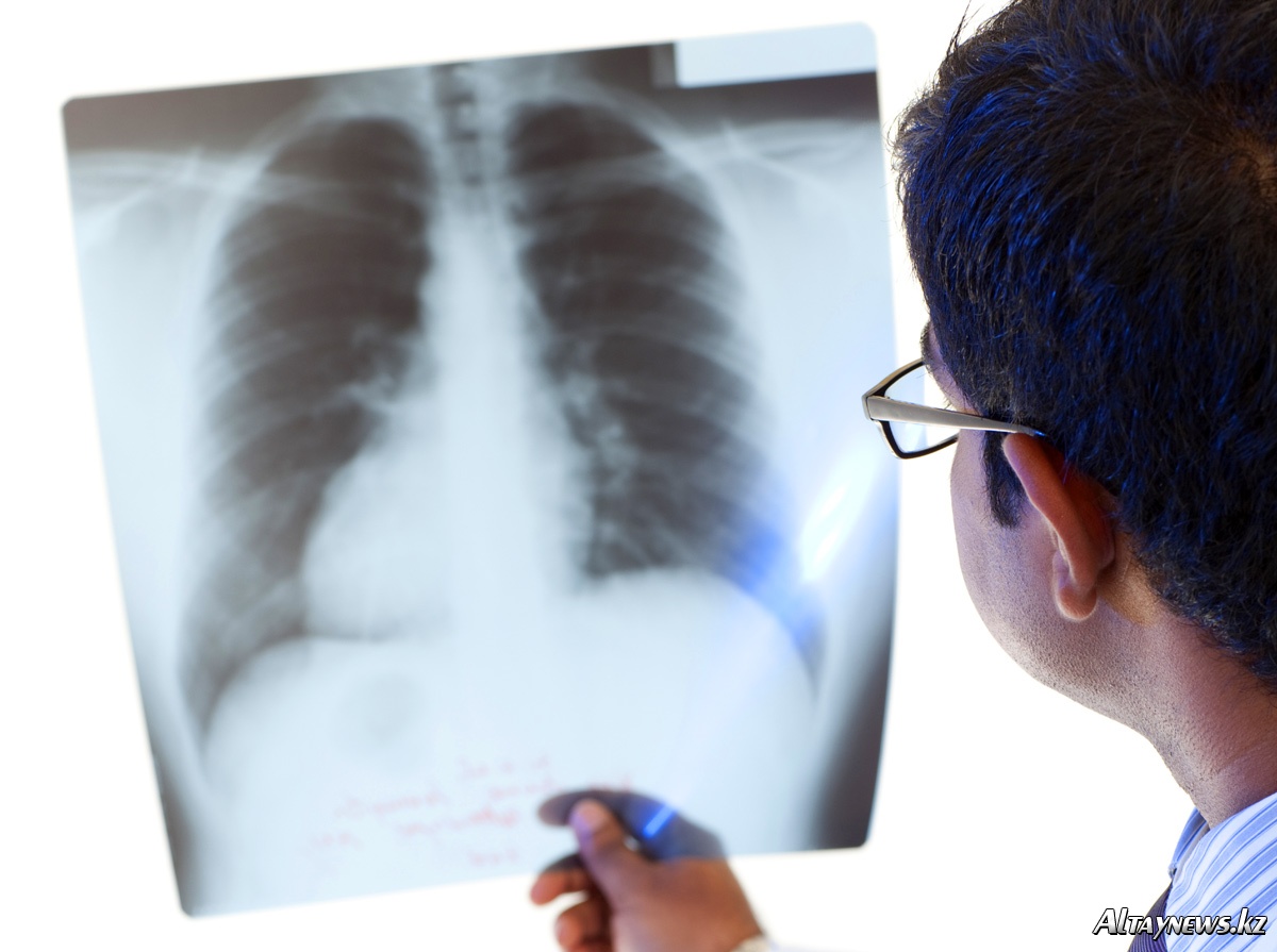 Заболеваемость туберкулезом за десять лет снизилась в разы в Новозыбкове 