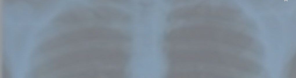 Рост внебольничных пневмоний отмечен в Злынке и Климово, а в Новозыбкове — снижение